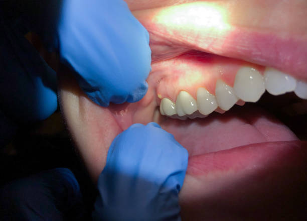Best Emergency Gum Treatment in Roseburg, OR